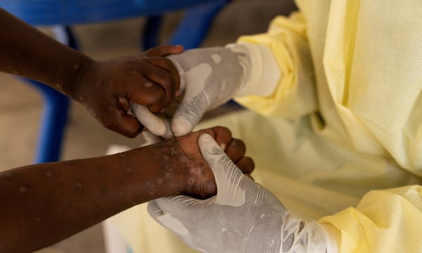 Mpox Outbreak in Africa Declared Public Health Emergency by WHO